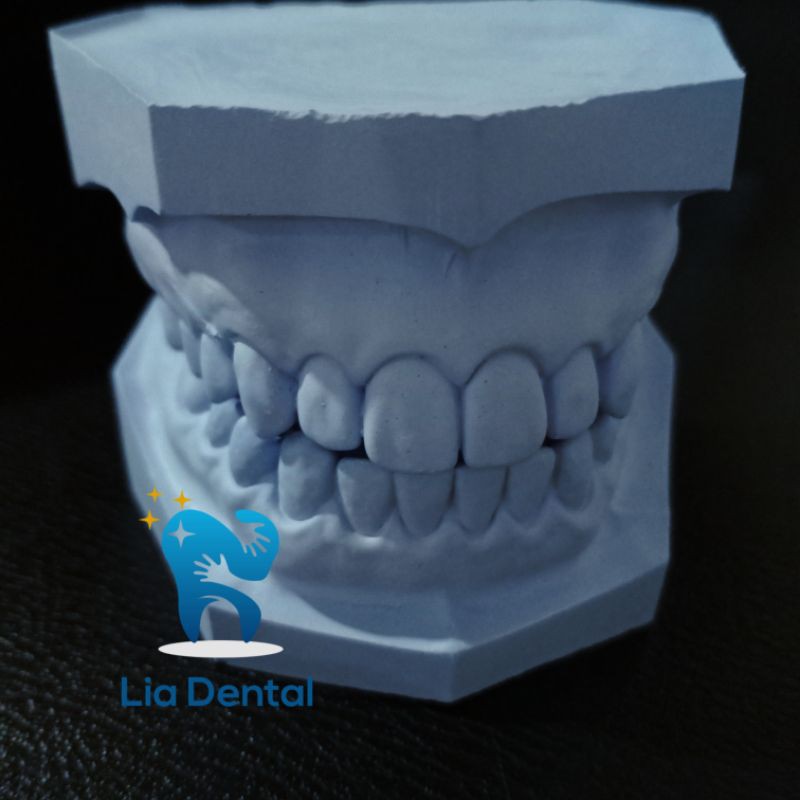 MODEL GIGI GIPS (1 PASANG)