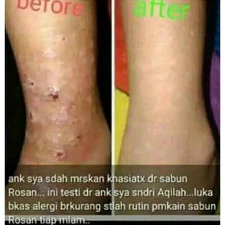 Sabun ROSAN Sabun Pemutih Badan Dan Wajah Rosan BPOM 100% by TARA Original / Sabun Pemutih Badan dan Wajah Glowing Permanen Wanita Pria / Sabun Pemutih Kulit Ketiak Selangkangan Seluruh Tubuh – Skincare Penghilang Bekas Luka, Noda Hitam Bekas Jerawat