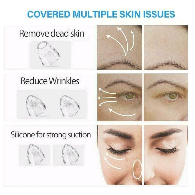 Alat Pembersih dan Penyedot Komedo / Alat Vakum Komedo / Alat Sedot Komedo / Blackhead Remover / Alat Facial Komedo / Alat Pembersih Komedo Praktis / Alat Menghilangkan Komedo Ampuh / Alat Penyedot Komedo / Alat Pembersih Wajah / Alat Membersihkan Komedo