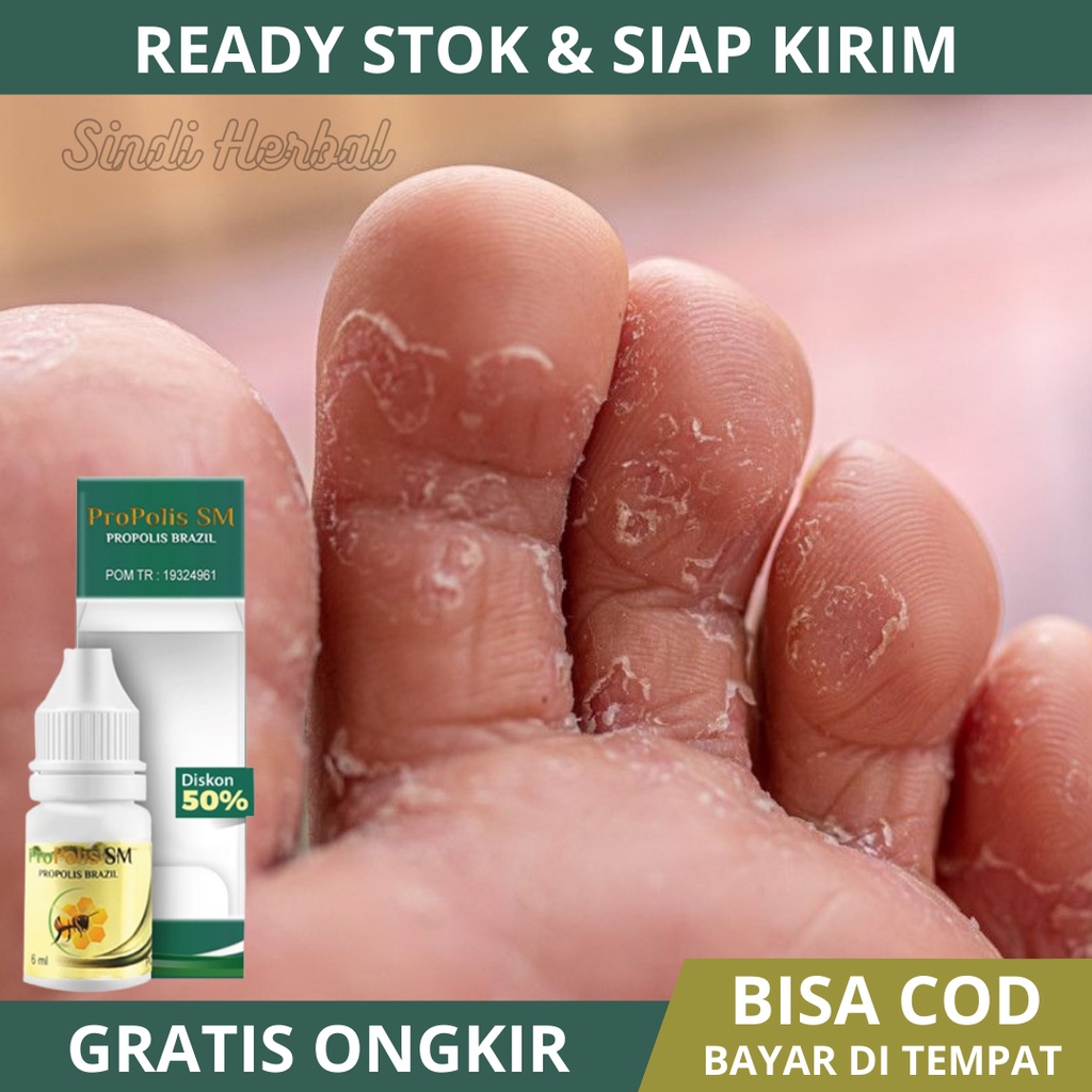 obat kutu air - obat kutu air untuk kaki - obat kutu air kaki - salep kutu air - Propolis SM Brazil 