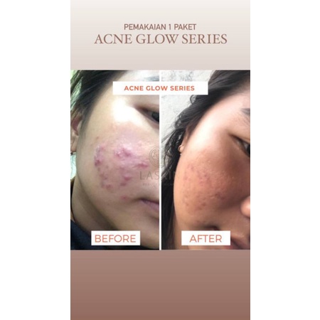LASKIN PAKET ACNE GLOW SERIES ( FREE POUCH )-4