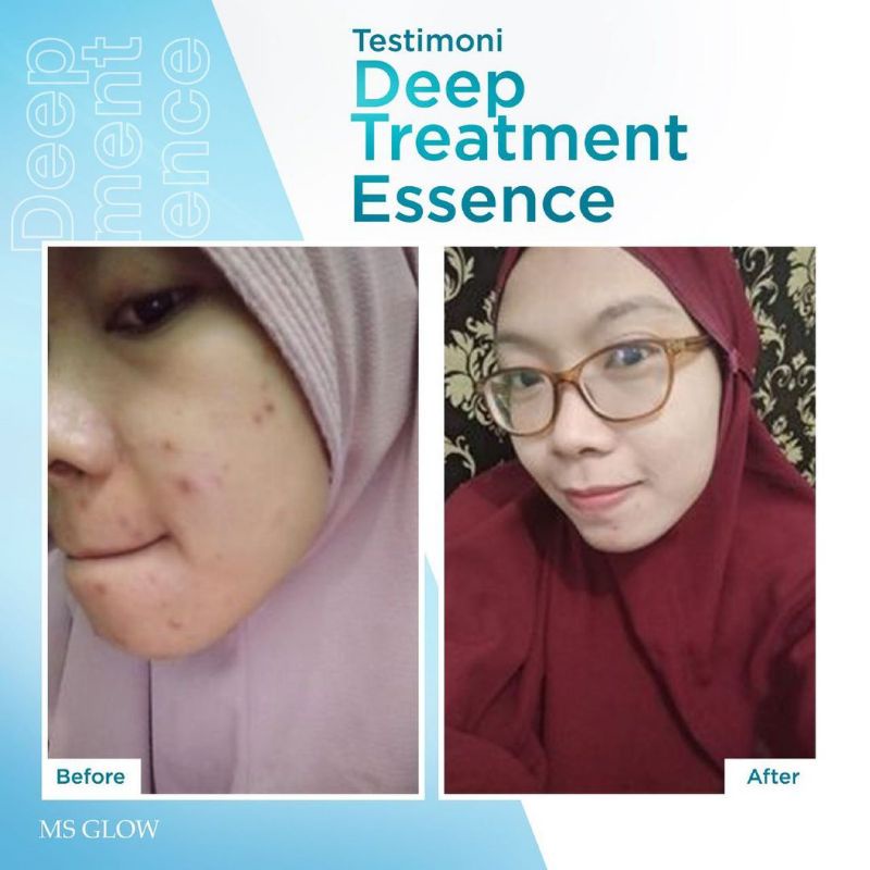 Ms Glow Deep Treatment Essence Centella Memperbaiki Skin Barrier