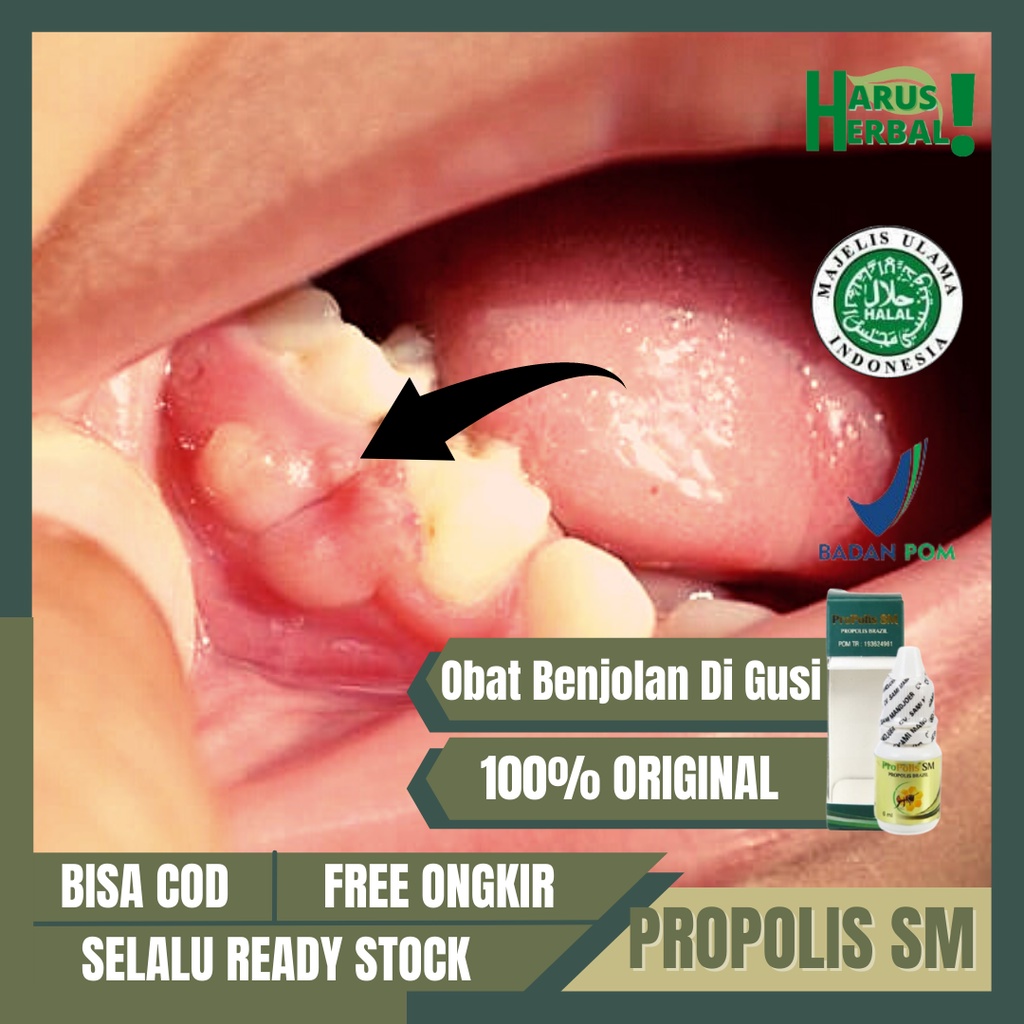 Obat Benjolan Di Gusi, Radang Gusi, Abses Gusi Bernanah, Obat Gusi Bengkak dan Sakit, Obat Penghilan