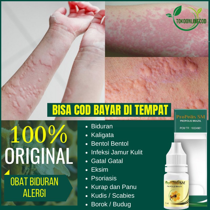 Obat Biduran Alergi - Obat Biduran - Obat Biduran Kronis - Obat Biduran Menahun - Propolis SM