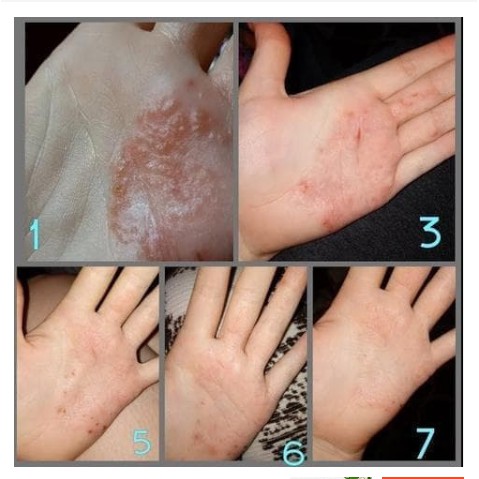 Obat Salep Gatal Gatel Kulit Kurap Jamur Bakteri Zudaifu Herbal-2