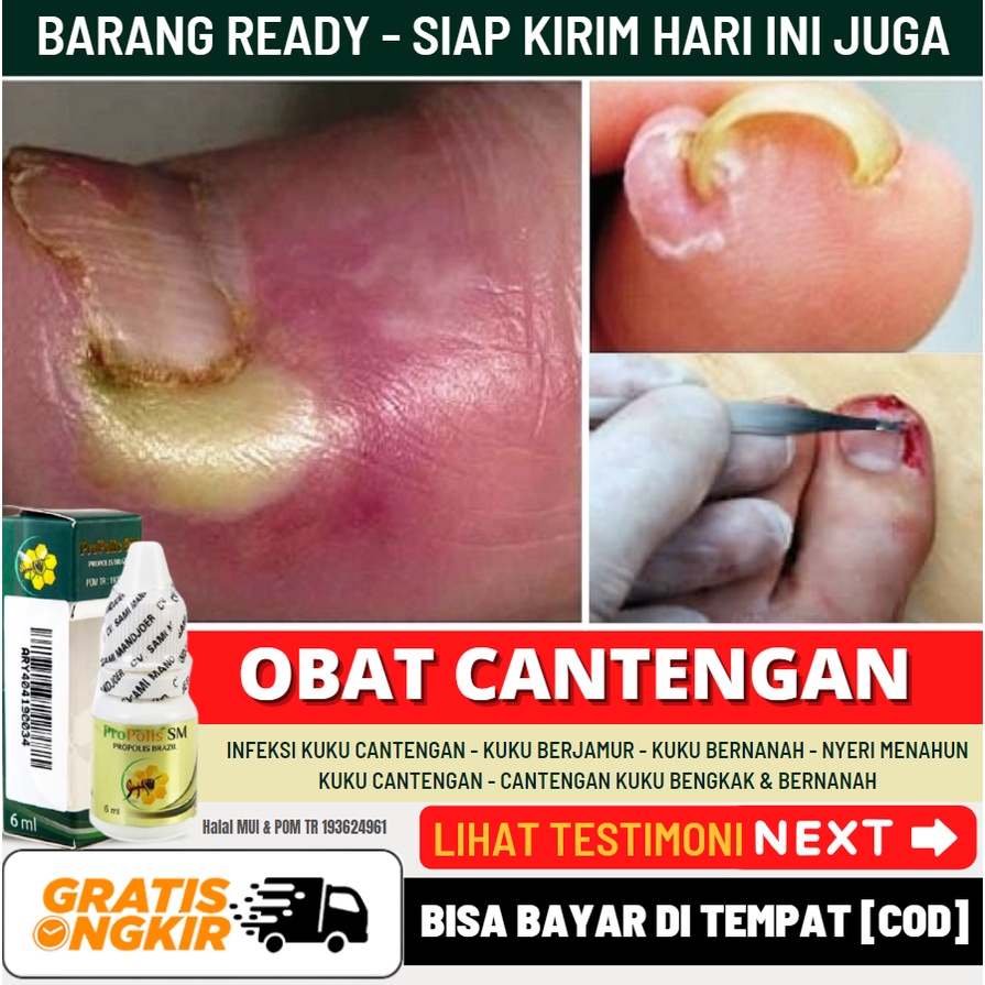 Jual Obat Cantengan Jempol Kaki Ibu Jari Kuku Cantengan Penumbuh Kuku Cantengan Yang Busuk