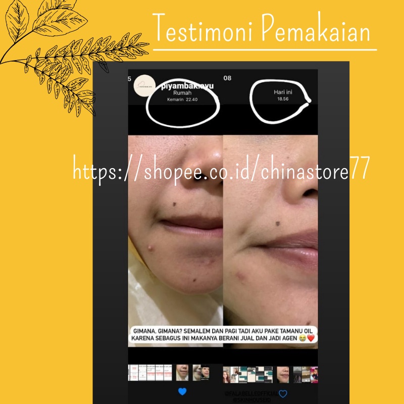 Serum Bopeng Wajah Penghilang  Bekas Jerawat Flex Hitam Bruntusan Bintik Hitam Stretch Mark TAMANU OIL 5ml Falabell  BPOM Oil