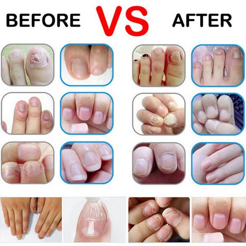 Serum Jamur Korea Kuli Pencil Cairan Obat Infeksi Anti Jamur Regenerasi Perawatan Kuku Kaki