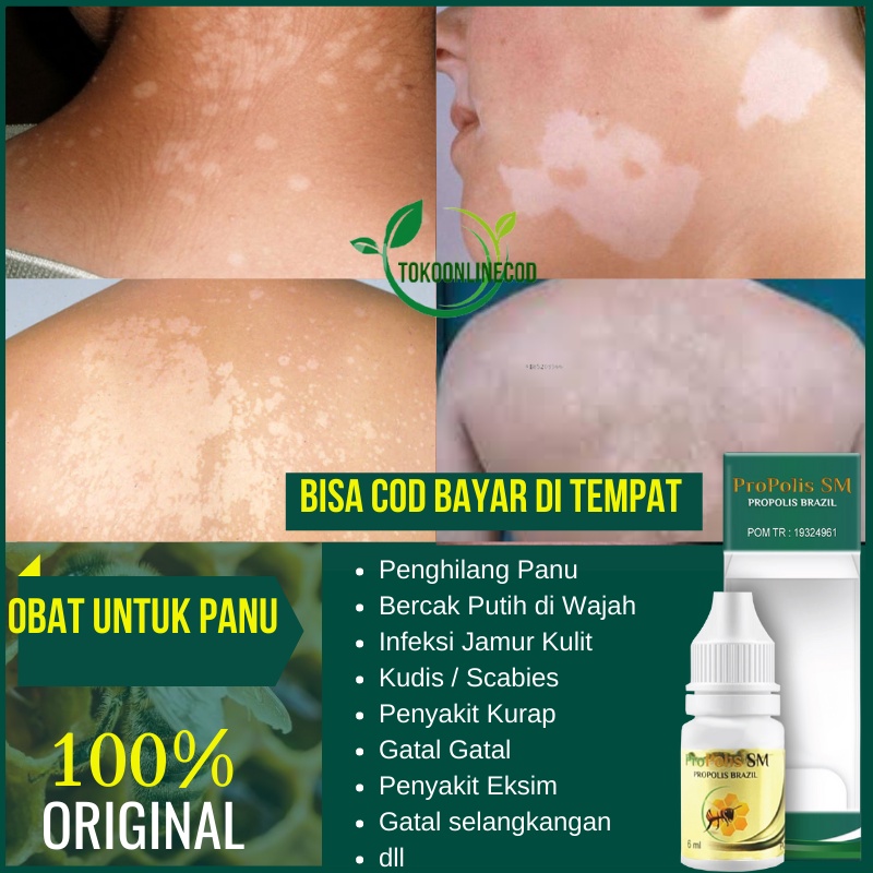 Obat Penghilang Panu, Bercak Putih di Wajah, Jamur Kulit di Selangkangan, Kurap dan Gatal di Pantat,