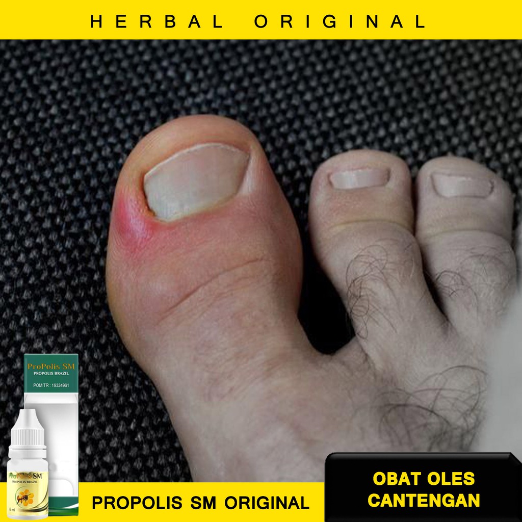 Propolis Sm Obat Cantengan Jempol Kaki Jempol Kaki Bernanah Cenang Bisul Jempol Kaki Berdarah Shopee Indonesia