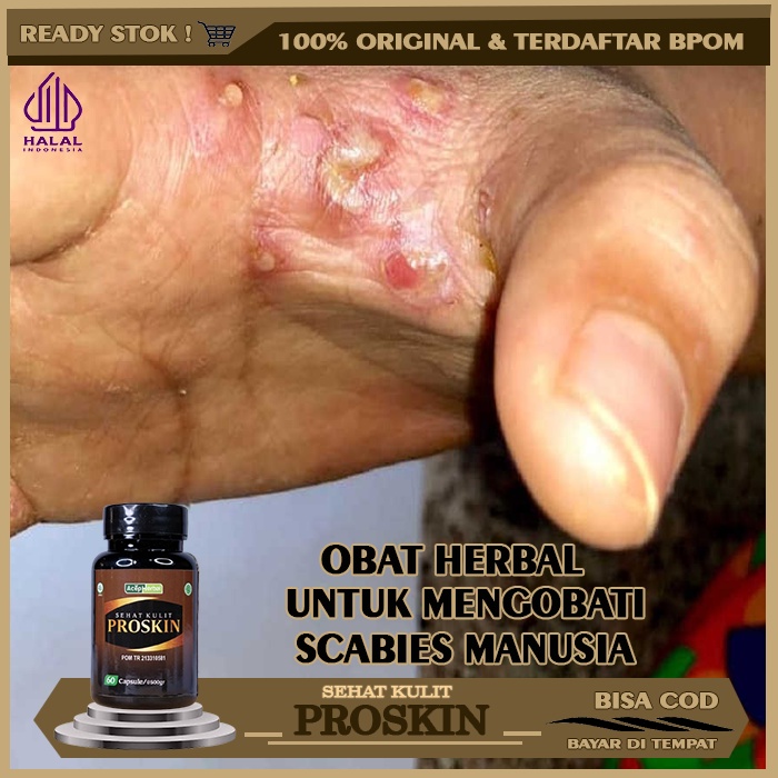 Obat Scabies Pada Manusia, Obat Kudis (Scabies) yang Aman, Obat Scabies Manusia Gudik Budug Koreng G