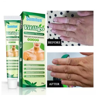 Sumifun Cream Salep Vitiligo Antibakteri Vitiligo White Spot Repigmentation - Salep Krim Penghilang Vitiligo Bintik Putih