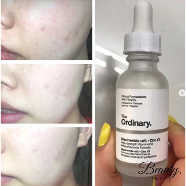 the ordinary niacinamide 10% + zinc 1% 30ml serum wajah untuk jerawat safa