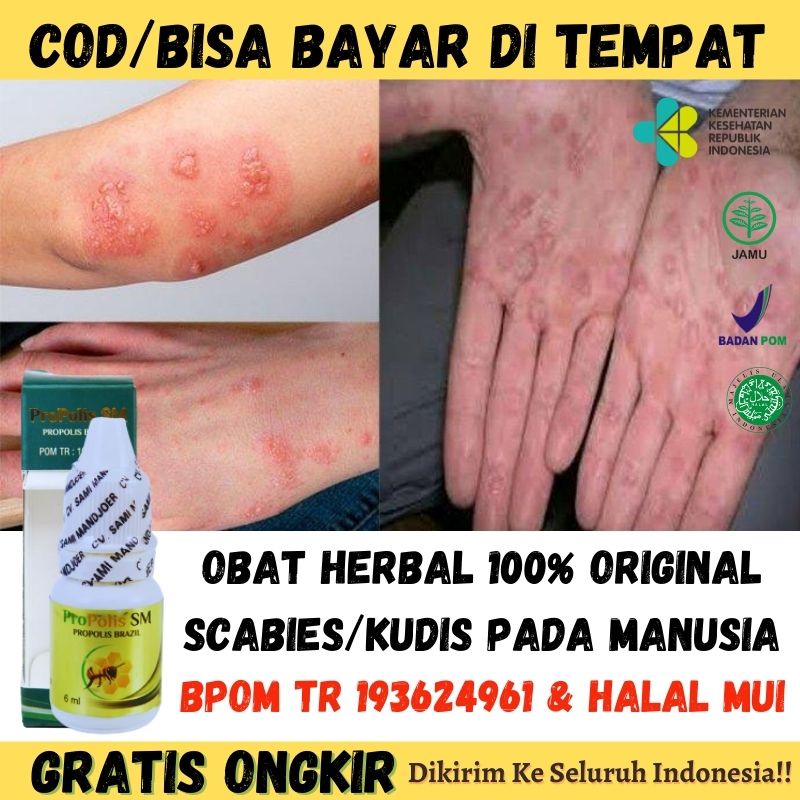 Obat Untuk Scabies Manusia - Herpes Bernanah - Gatal Gatal dan Bernanah - Obat Herbal Salep Borok - 