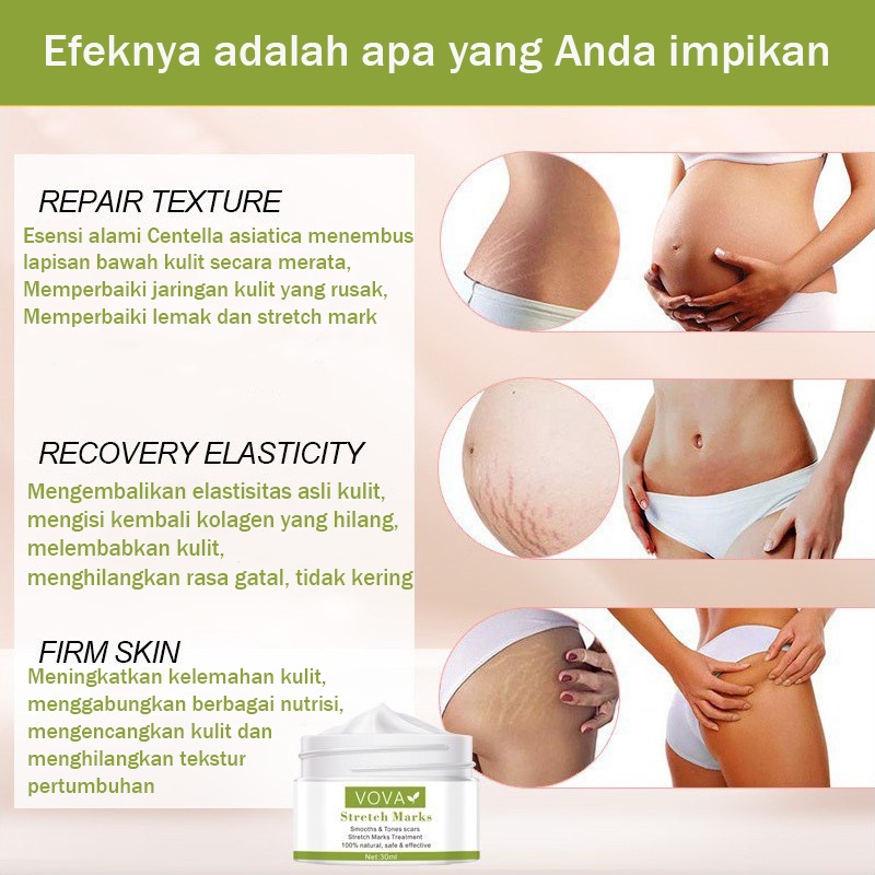 Stretch Mark Cream Mama Choice Stretch Mark 30ml  Stretch Mark Dan Obesity Mark Krim Mengencangkan Perut Stretch Mark Removal Cream Krim Perawatan Postpartum