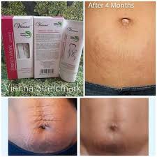 VIENNA STRETCHMARK CREAM PENGHILANG SELULIT TUBUH