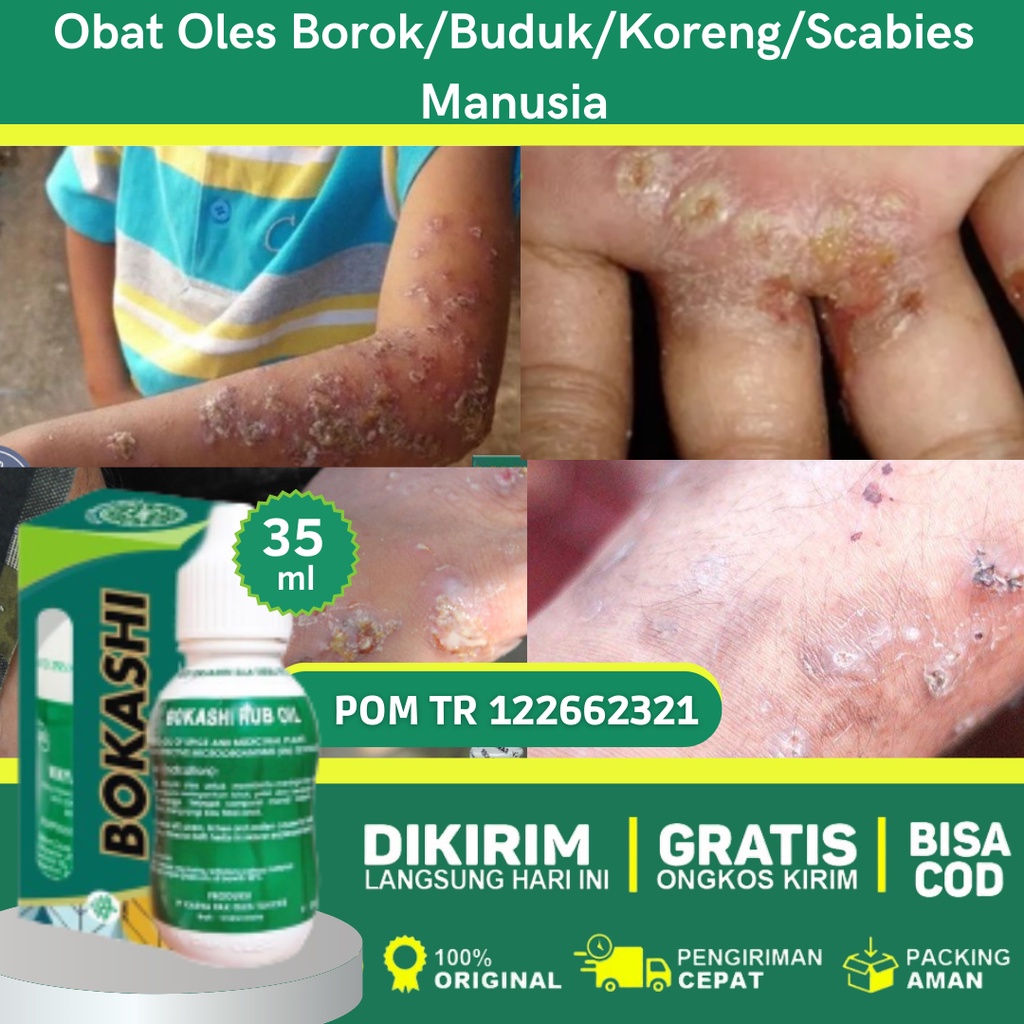 Obat Scabies Manusia, Obat Budug Bernanah, Obat Luka Bernanah, Obat Tetes Borok, Obat Gudik / Kudis,