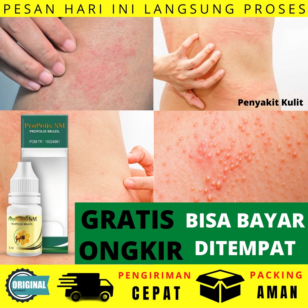 Obat Biang Keringat - Biduran