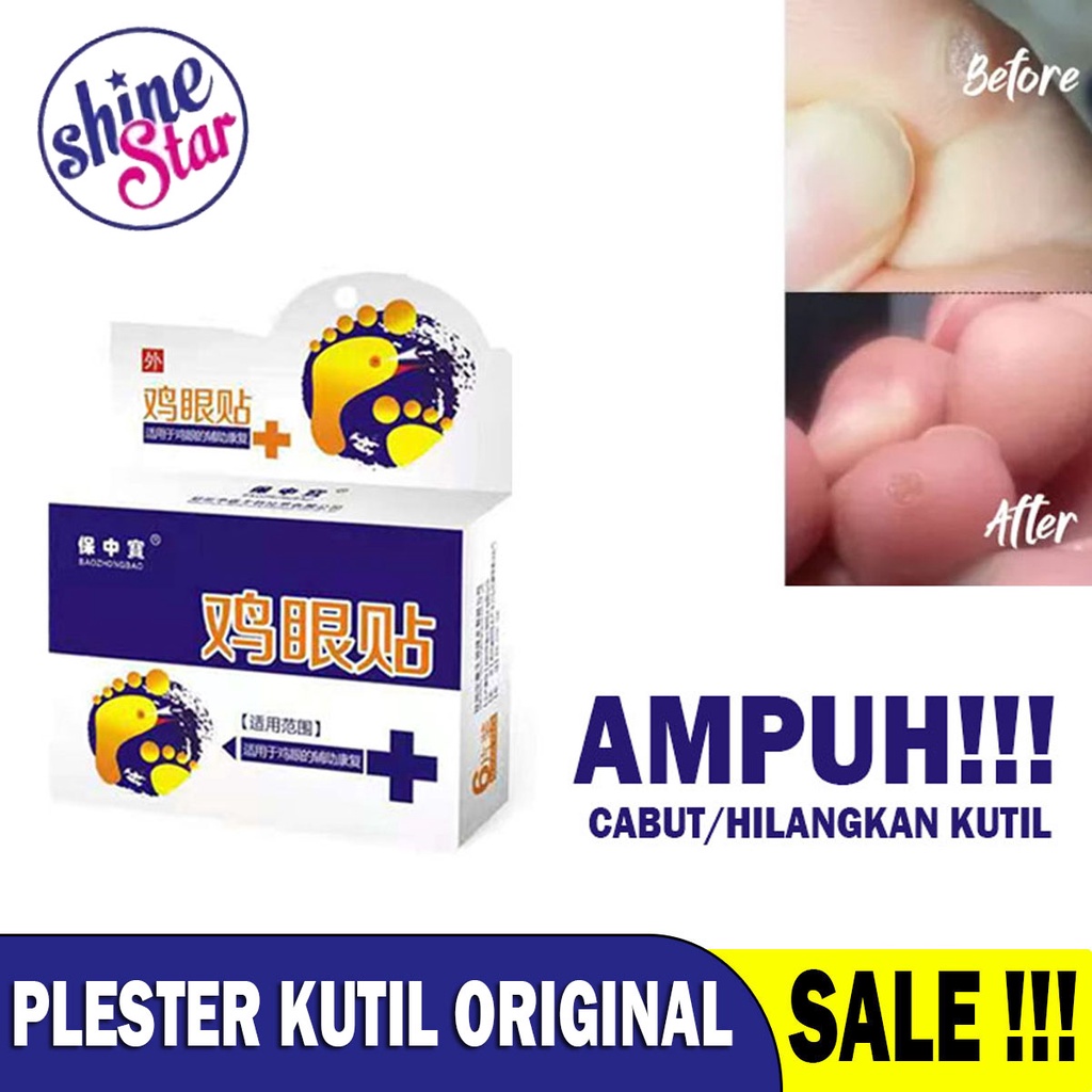 SHINE STAR - [1 BOX 6 PCS]  PLESTER OBAT MATA IKAN KAKI KUTIL DAN KAPALAN AMPUH MENGOBATI KUTIL DAN MATA IKAN