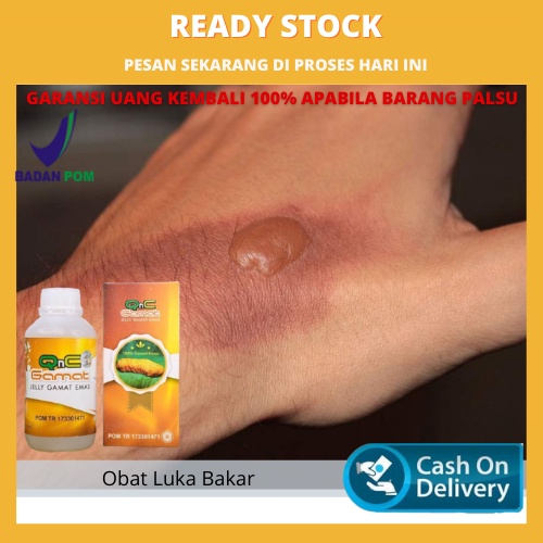 Obat Herbal Luka Bakar, Luka Bakar Melepuh, Berair, Luka Bakar Bengkak, Menggelembung Bernanah, Nyer