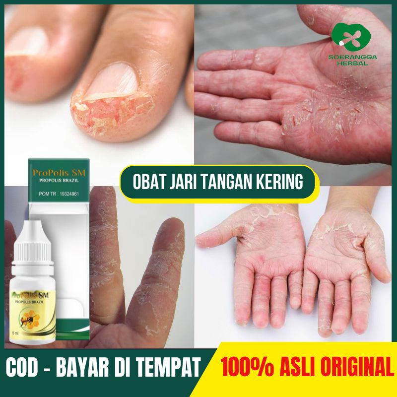 Obat Jari Tangan Kering Mengelupas Jari Tangan Pecah Pecah Obat Oles Kulit Kering Gatal Gatal di Kak