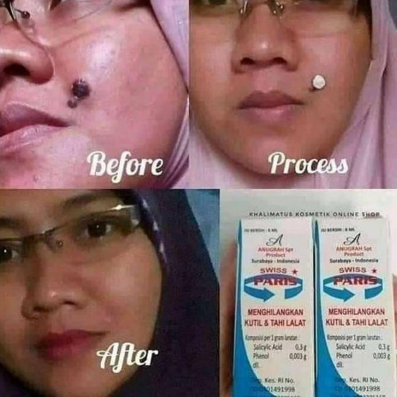 [ ORIGINAL ] OBAT KUTIL DAN PENGHILANG TAHI LALAT WAJAH KAKI MATA IKAN AMPUH SWISS PARIS LOTION BPOM