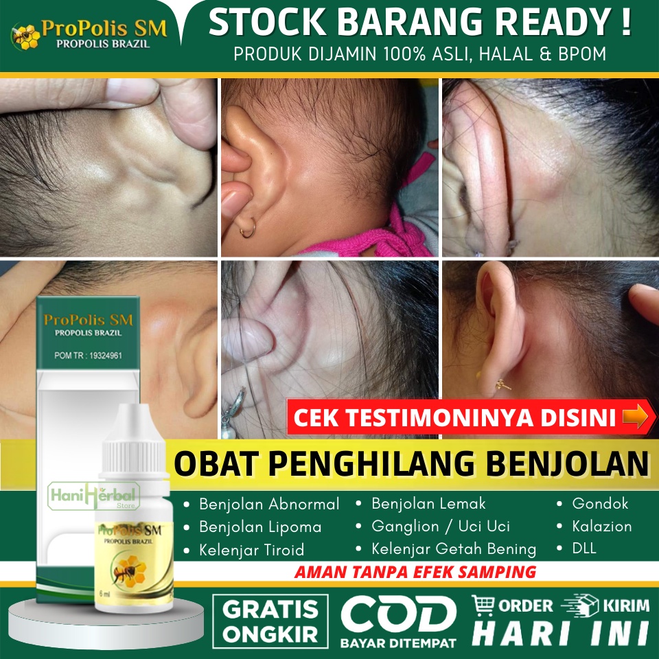 OBAT BENJOLAN DI BELAKANG TELINGA - PENGHILANG BENJOLAN ABNORMAL - BENJOLAN LIPOMA - TUMOR JINAK - K