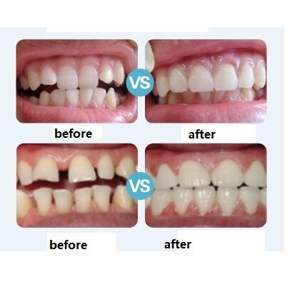 [Putih] Perapi Gigi Tanpa Behel dari Bahan Silikon Orthodentic Retainer Teeth Ampuh dalam 3 Bulan