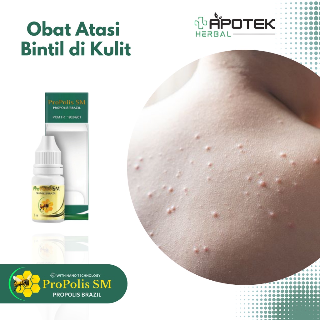 Obat Bintil untuk Anak & Dewasa, Bintilan di Kulit, Keloid, Daging Tumbuh, Tetes Kutil Kelamin, Mata