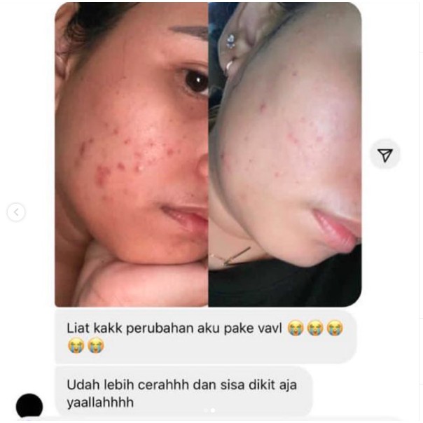 Skinhouseid Vightne Sunscreen Blemish Serum Vavl Beauty Water Original Perawatan Kulit Wajah Berjerawat BPOM