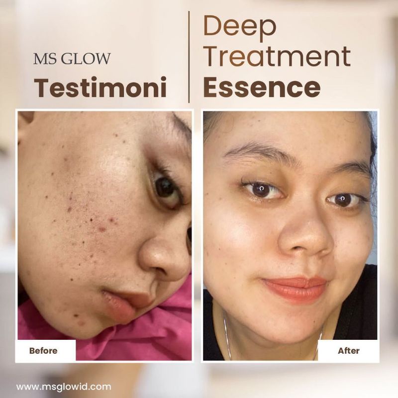 DTE SALMON DNA Deep Treatment Essence. MS GLOW.