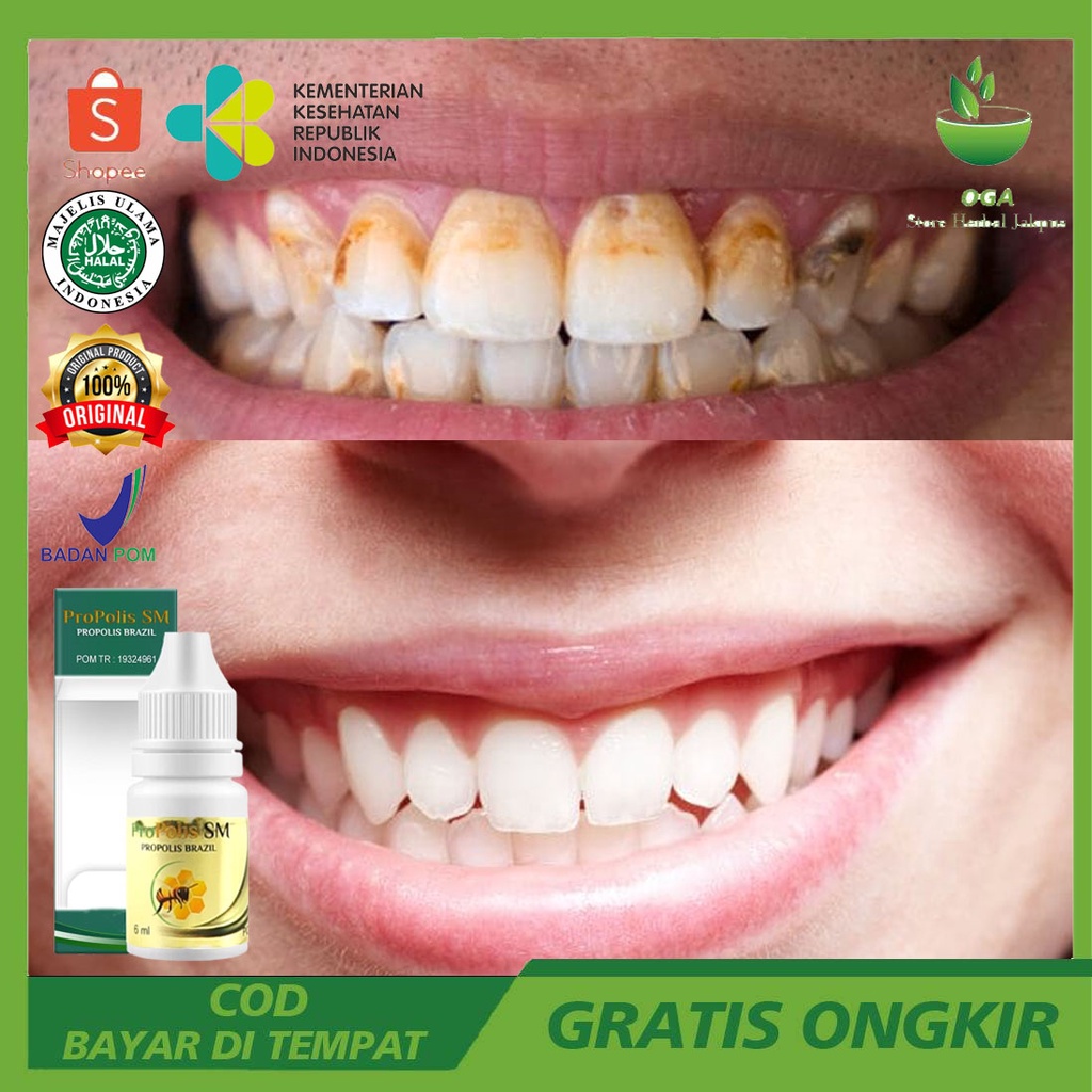 Obat Perontok Karang Gigi, Obat Karang Gigi Cepat Rontok, Pembersih Karang Gigi, Pembersih Gigi Kuni