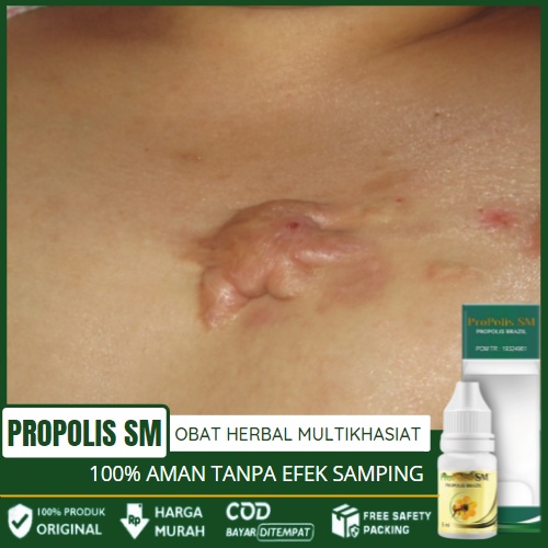 Obat Keloid Menonjol Di Dada, Obat Keloid Menonjol Tahunan, Menghilangkan Keloid, Herbal Penghilang 