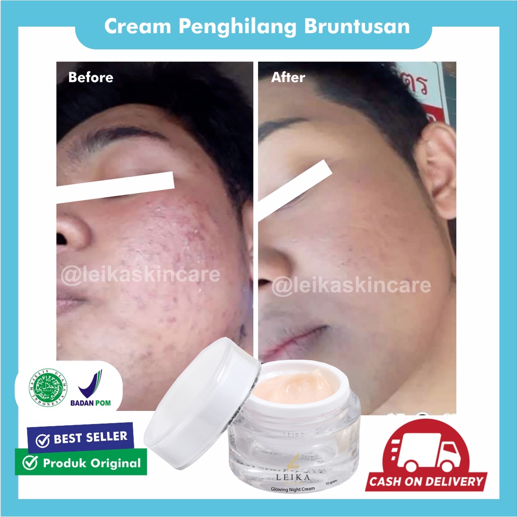 Krim Wajah Penghilang Bruntusan Penghilang Jerawat Dan Bekas Jerawat Obat Bruntusan Wajah Cream Sian