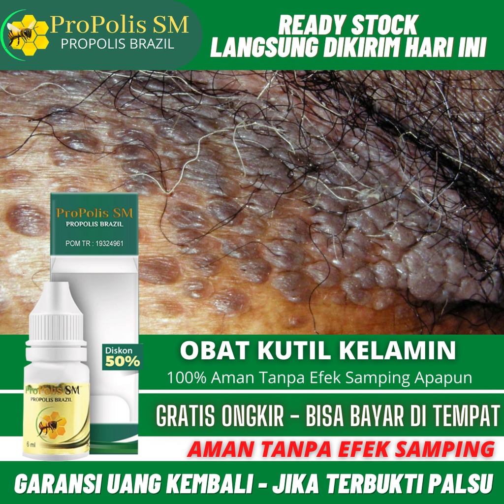 Obat Kutil Kelamin Pria dan Wanita, Obat Tetes Perontok Kutil Kelamin, Penghilang Kutil Kelamin, Jen