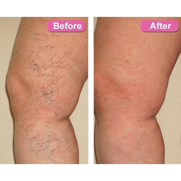 Obat varises Salep penghilang Varises Tanpa Operasi - Varicose Veins Treatment Cream