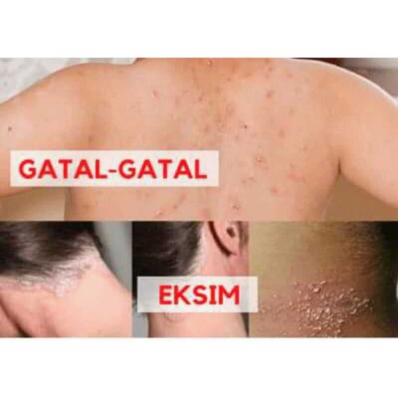 Grade Ori Obat Biduran Alergi Ampuh Saleb BL Original 100% Asli salep gatel selangkangan jamur Pi Kang Shuang panu kadas kudis kurap bruntusan-6