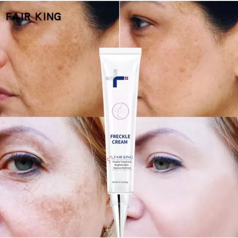 FAIR KING EFFECTIVE FRECKLE CREAM REMOVE DARK SPOT WHITENING CREAM FADE ACNE MELASMA-ANTI AGING SKIN LIGHTENING- CREAM PEMUTIH-KRIM PEMUTIH-WAJAH GLOWING KRIM-CREAM PENGHILANG FLEK-WAJAH CREAM SIANG MALAM-CREAM WAJAH GLOWING-20ml