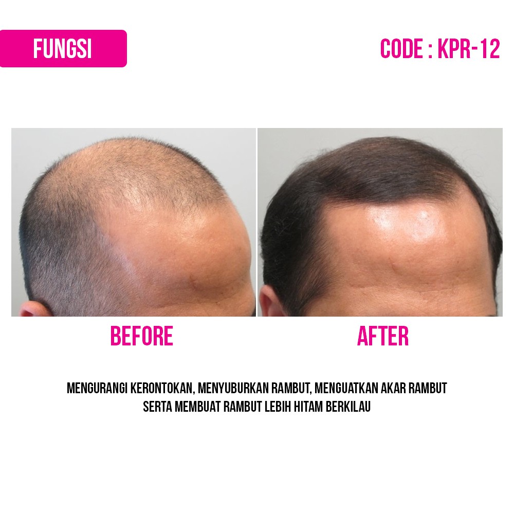 BMKS HAIR TONIC tonik spray kemiri pelurus penumbuh pemanjang penyubur perawatan penebal pelebat penghitam vitamin serum toner rambut botak dan rontok dan ketombe parah beruban care treatment penumbuh pelurus rambut cepat pria wanita permanen