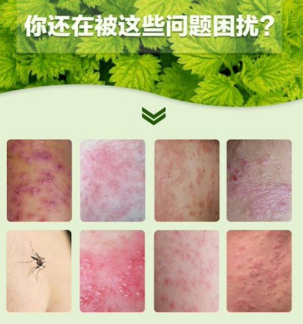 Zudaifu Psoriasis Cream 100% Original