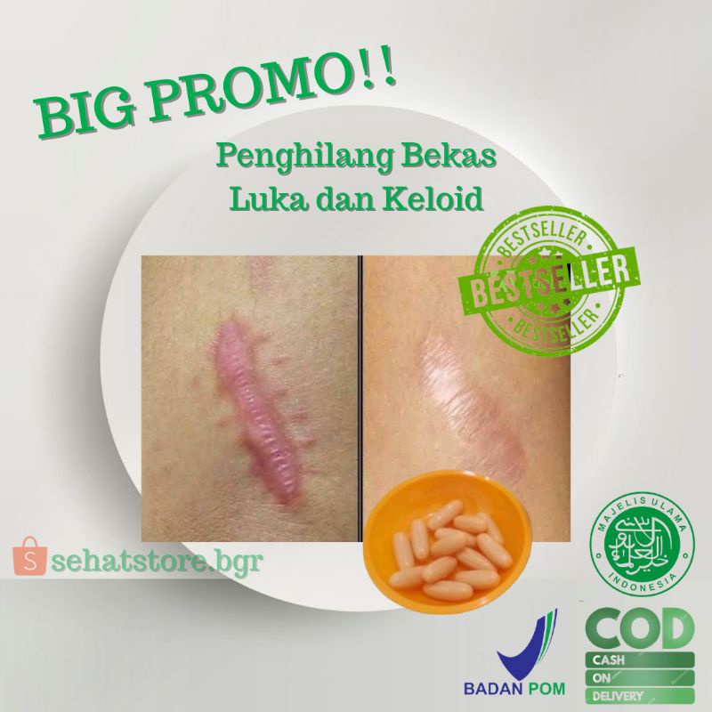Vitaline Softgell Penghilang Bekas Luka Kering, Luka bakar dan keloid (bisa cod)