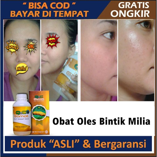 Jual Obat Oles Bintik Milia Menghilangkan Benjolan Kecil Di Hidung Pipi Bawah Mata