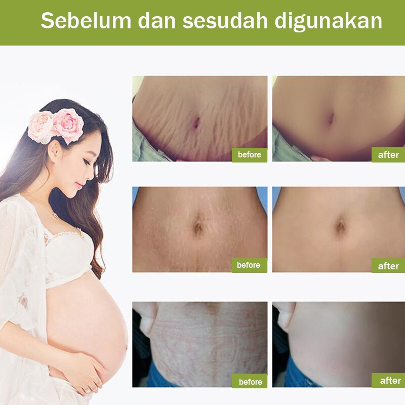 Stretch Mark Cream Mama Choice Stretch Mark 30ml  Stretch Mark Dan Obesity Mark Krim Mengencangkan Perut Stretch Mark Removal Cream Krim Perawatan Postpartum