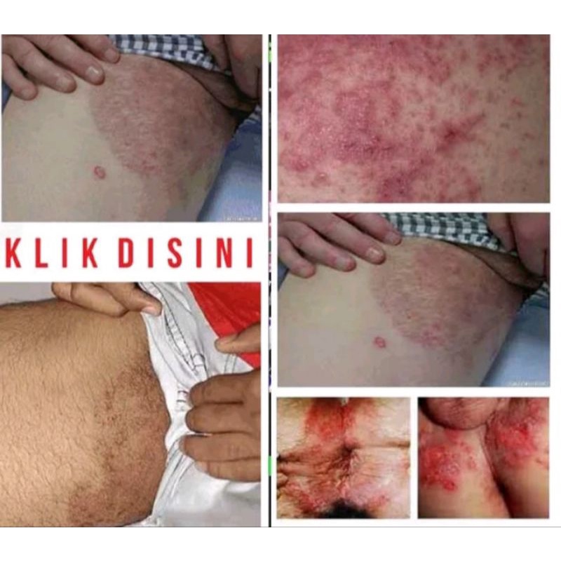 Obat Masalah Kulit Gatal Di Selangkangan Pria Wanita Eksim Exim Kering Basah Obat Gatal Alergi Biduran Obat Gatal Jamur Kulit Kadas Kurap Shopee Indonesia