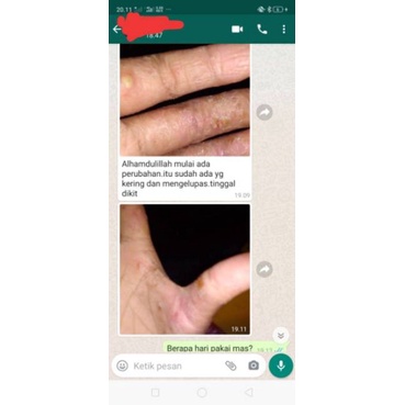 Salep Obat Gatal Selangkangan Saleb Gatel Kurap Herpes Herves Panu Alergi Kulit Eksim Paling Ampuh-6