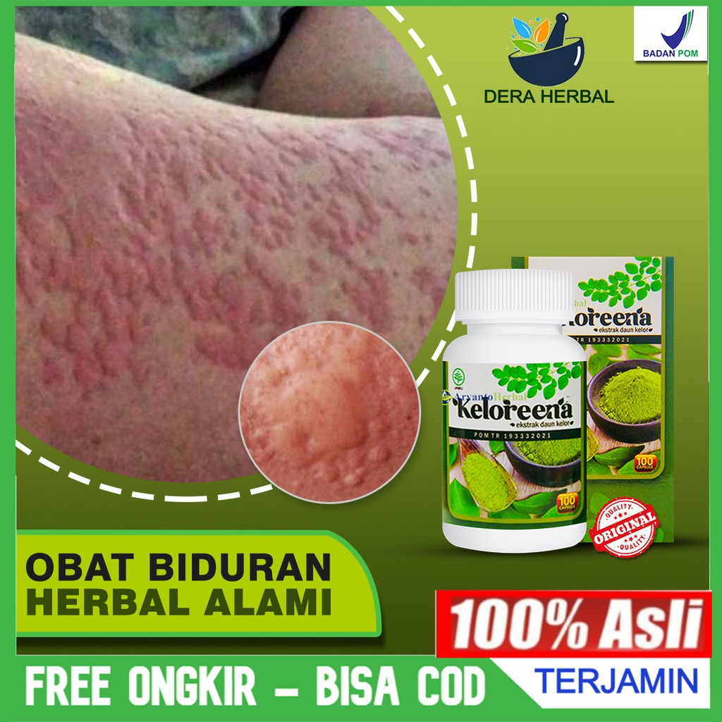 Obat Untuk Atasi Biduran Gatal Gatal Alergi Dingin Gatal Di Selangkangan Keloreena Kapsul Bisa Cod Shopee Indonesia