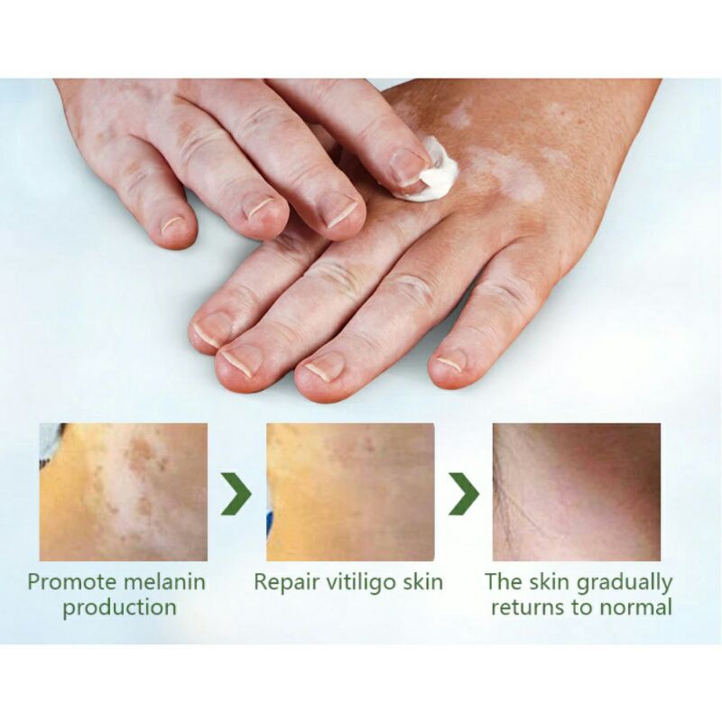 Sumifun Cream Salep Vitiligo Antibakteri