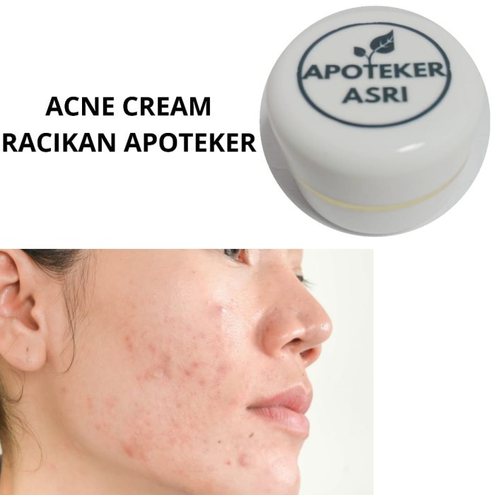 Krim Acne Cream Clindamycin Obat Jerawat Radang Racikan Apoteker Asri - Best Seller - AMAN