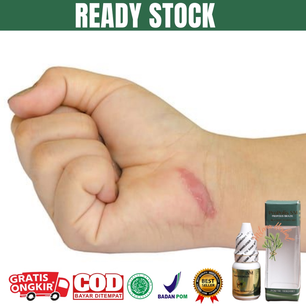 Harga Bekas Luka Keloid Terbaru November 2021 Biggo Indonesia
