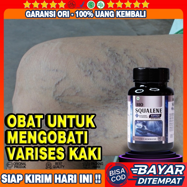 Obat Varises di Kaki - Obat Alami Varises - Obat Untuk Varises - Obat Varises Bengkak - Obat Varises